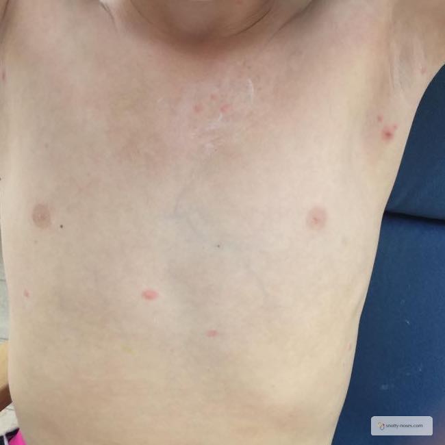 Chicken Pox in Children by Dr Orlena Kerek