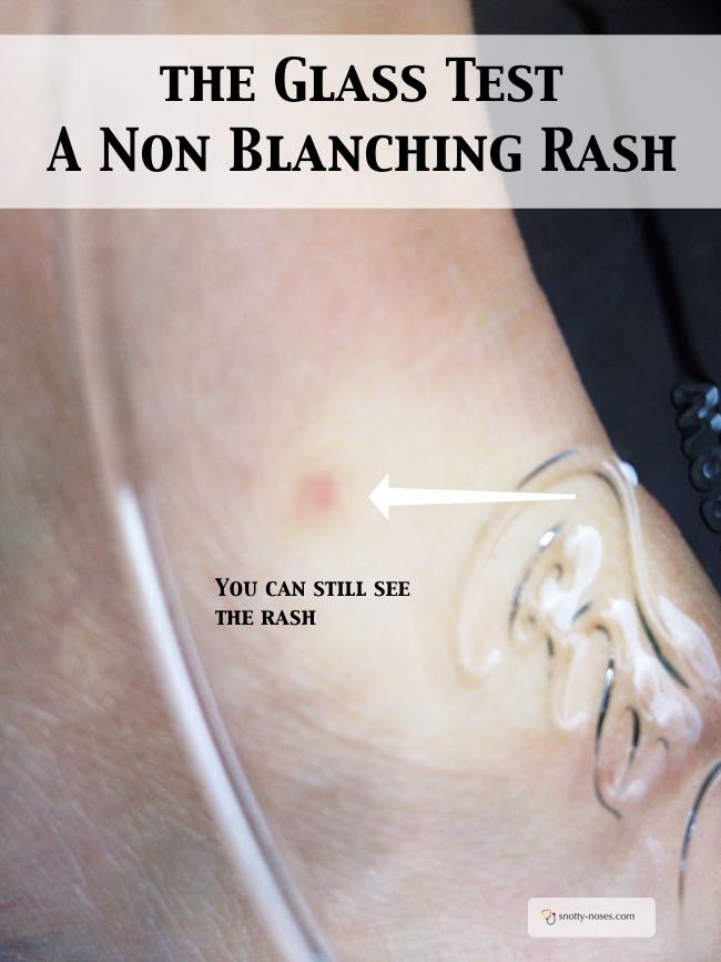 Blanching And Non Blanching Rashes Snotty Noses