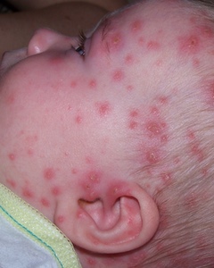 babies with chicken pox