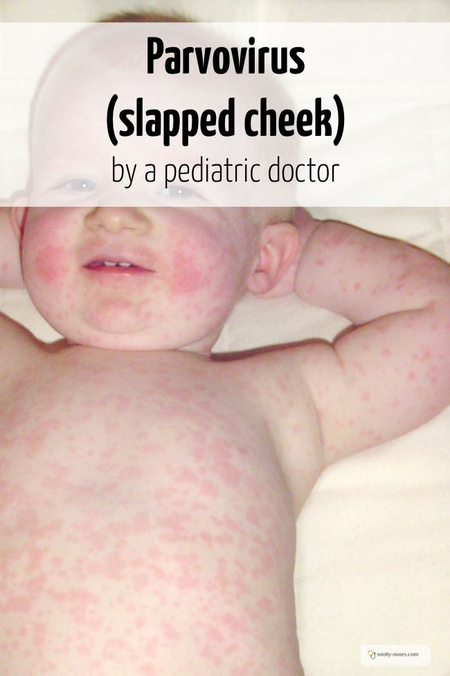 Slap Cheek is also known as parvovirus, fifth's disease or slapped cheek syndrom. It is a very common childhood infection. Written by a pediatric doctor.