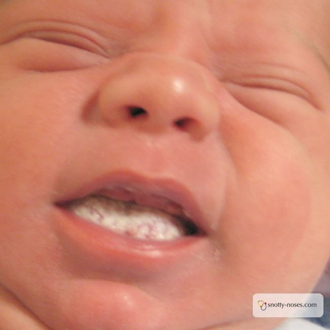 Do Babies Get Nappy Rash When Teething