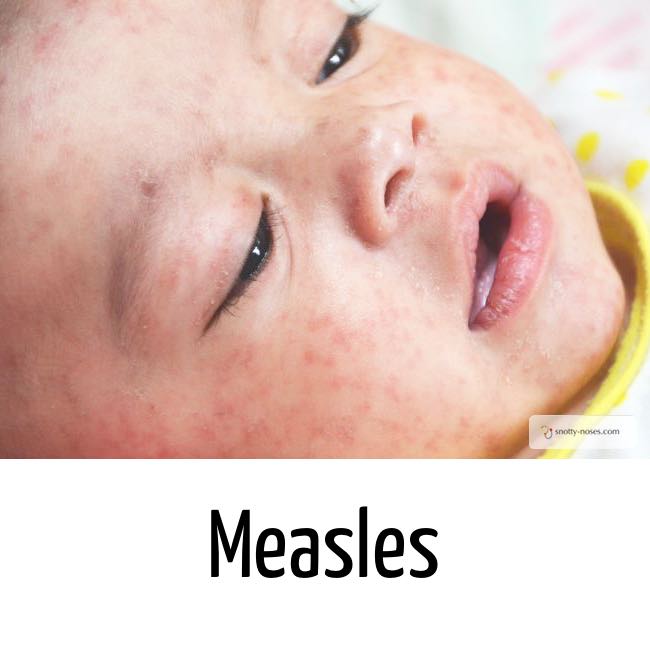 Measles rash on a child's face. This is a typical maculopapular rash of measles by Dr Orlena Kerek