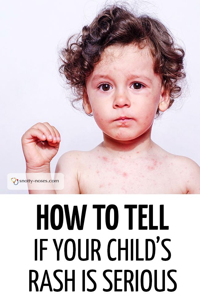 viral rash in children face