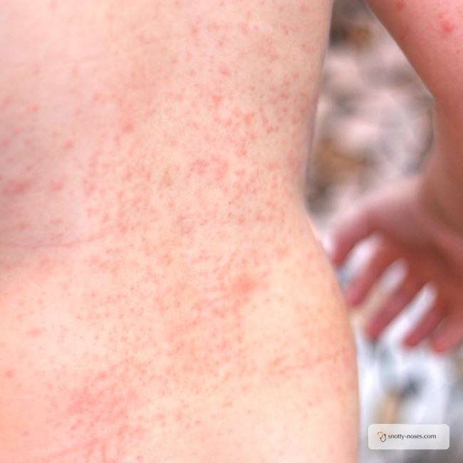 Natural Remedies For Heat Rash In Children