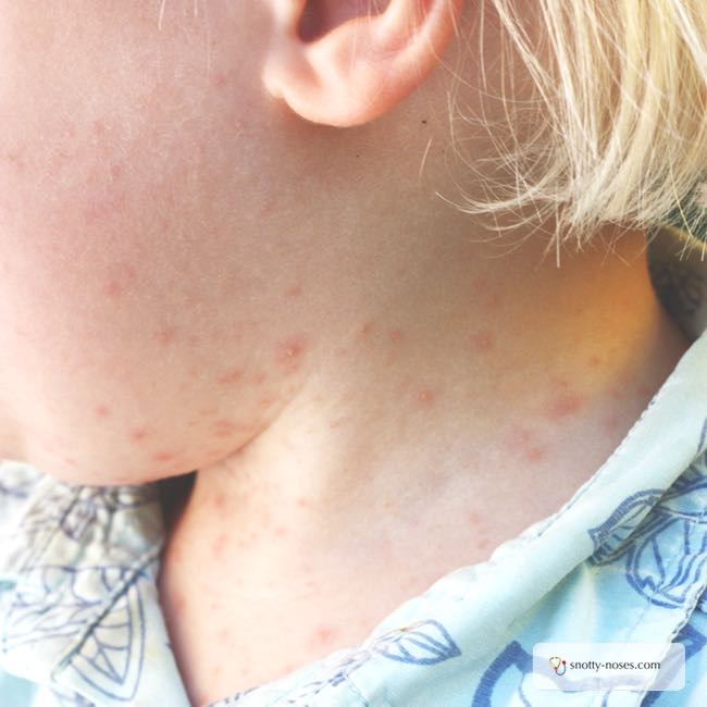 heat rash on face toddler