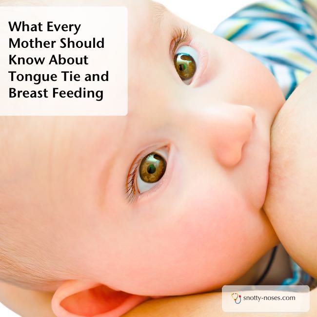 A Tongue Tie Cut can help Breastfeeding