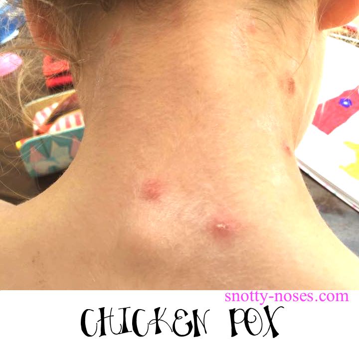 mild chicken pox pictures early stages