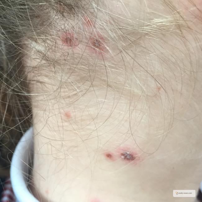 Chicken Pox in Children by Dr Orlena Kerek. A child's neck with chicken pox scabs.