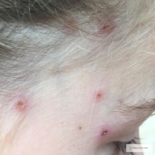 Chicken Pox In Children Snotty Noses