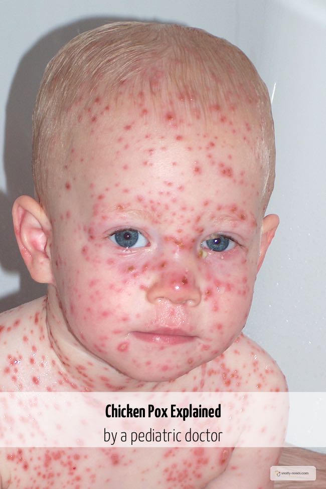 Chicken Pox in Children by Dr Orlena Kerek. A boy with chicken pox rash all over his body