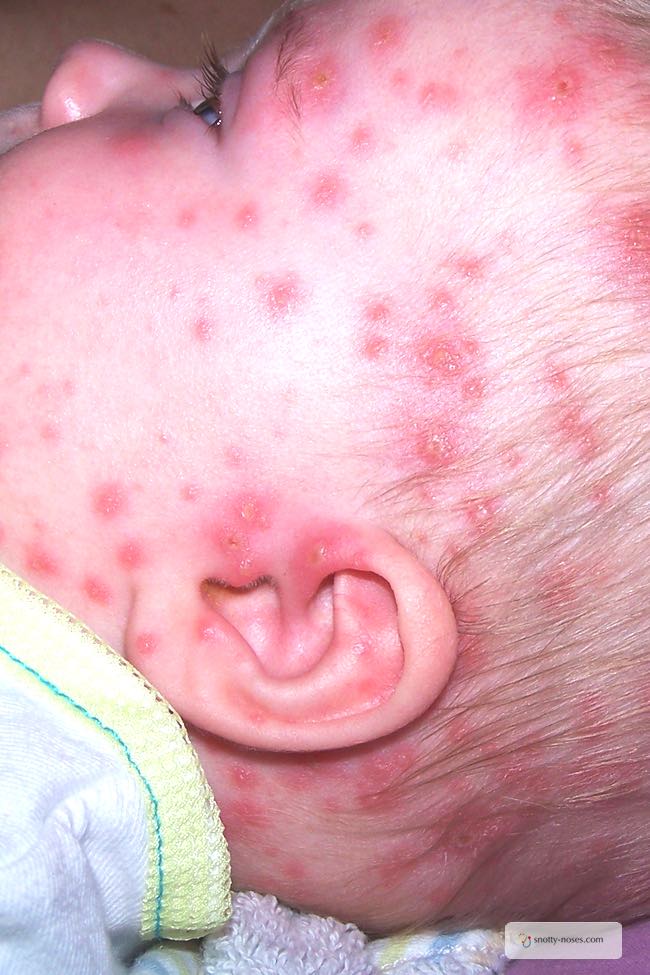 Chicken Pox in Children, Snotty Noses