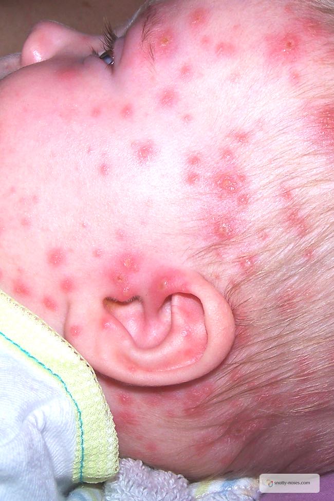 chicken pox on babies