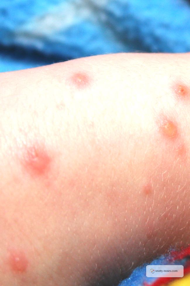 Chicken Pox in Children by Dr Orlena Kerek. A boy's leg with watery chicken pox blisters