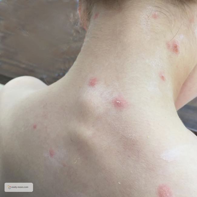 Chicken Pox in Children by Dr Orlena Kerek. A child's trunk with early chicken pox lesions