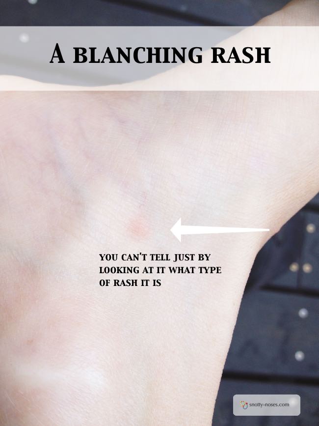 How can you tell if a child's rash is blanching or not? Do the glass test to find out if is a blanching rash.