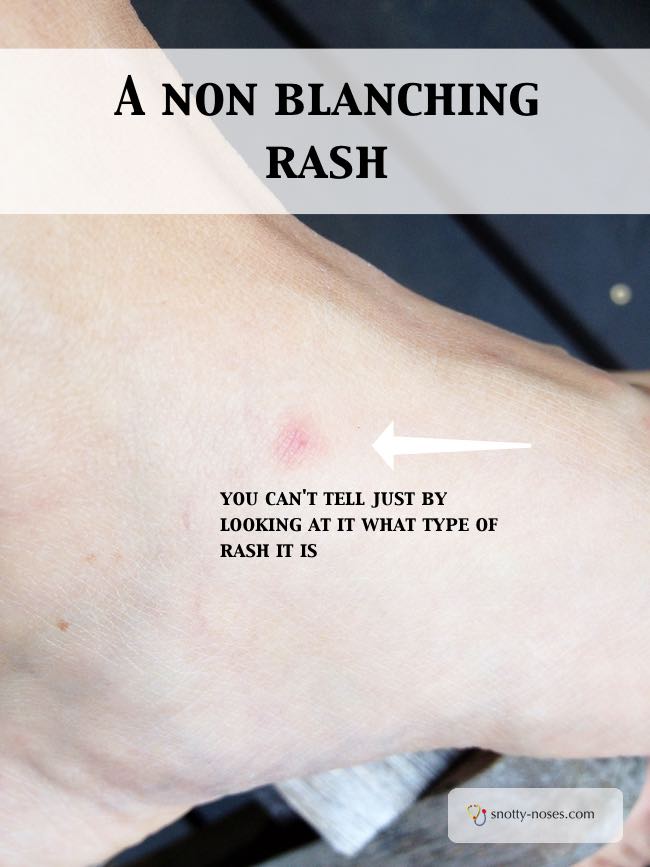 How can you tell if a rash is blanching or not. A non-blanching rash looks the same as a blanching rash. Do the glass test to find out the difference.