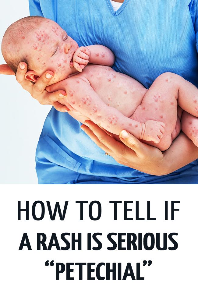 An unwell baby with a florid red rash all over her, being held by her medical staff who isn't sure if the rash is serious or not. #childhealth #illchild #rashkids #rash #sickchild #parenting #unwellbaby #sickbaby