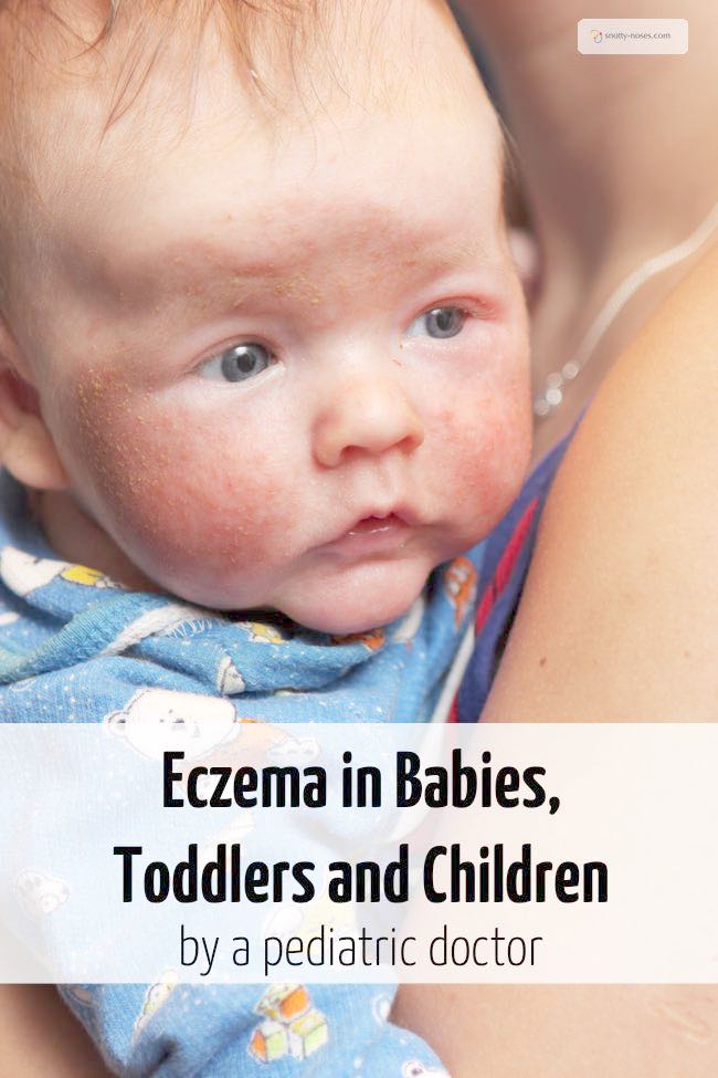 Eczema in Babies, Toddlers and Children Snotty Noses