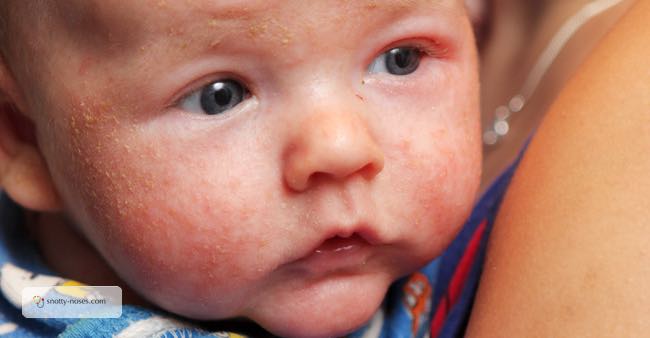 Eczema in Babies, Toddlers and Children Snotty Noses