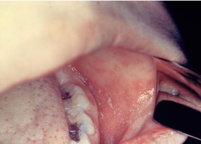 Koplik spots inside a mouth. They are difficult to see but are the hallmark of Measles