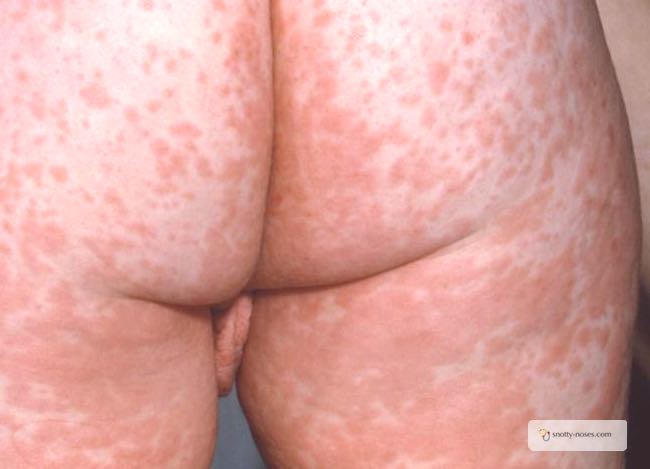 Measles rash on a child. This is typical of the blothcy confluent rash of measles.