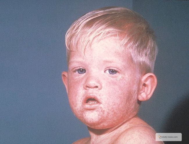 Measles rash on a child's face. Day 3 of the rash.
