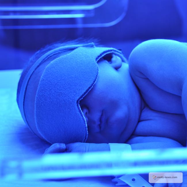 phototherapy for jaundice