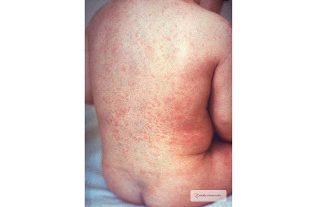 German Measles is a mild virus in children. It is dangerous for pregnant women and can result in congential rubella syndrome. By a pediatric doctor.