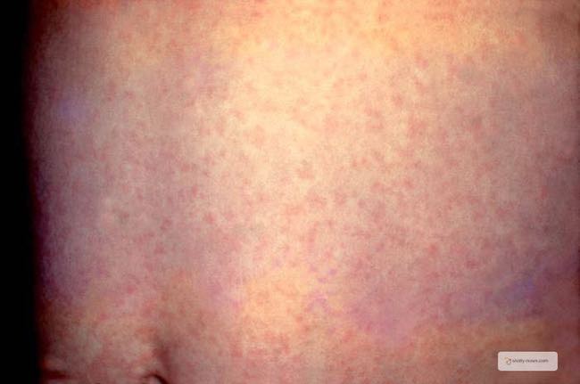 German Measles is a mild virus in children. It is dangerous for pregnant women and can result in congential rubella syndrome. By a pediatric doctor.