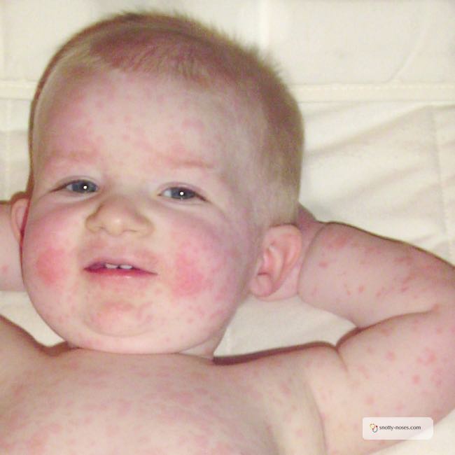 Slap Cheek is also known as parvovirus, fifth's disease or slapped cheek syndrom. It is a very common childhood infection. Written by a pediatric doctor.