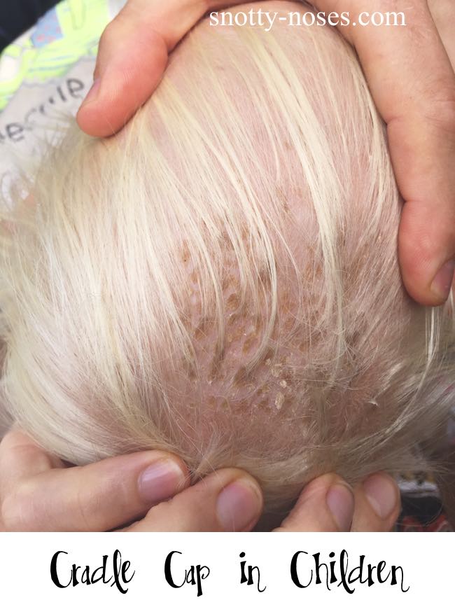 Cradle Cap (sebhorreic dermatitis) on a Baby's Scalp. A common complaint that normally resolves itself