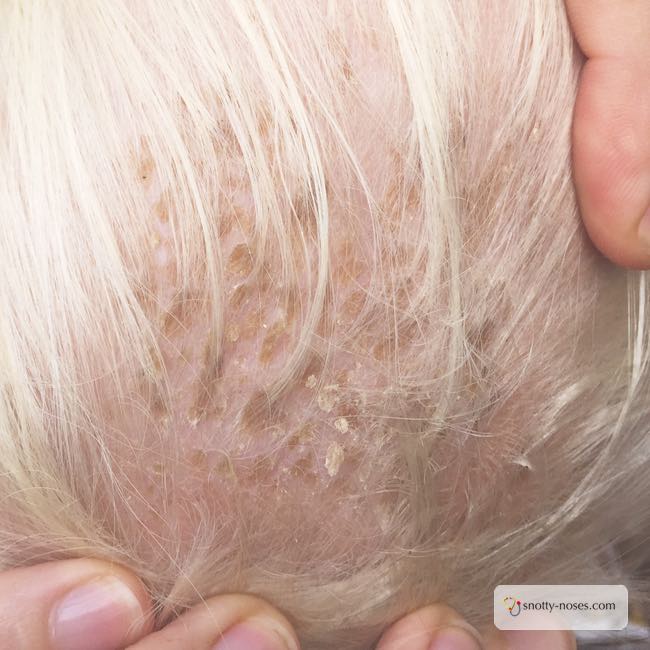 Cradle cap shop in kids