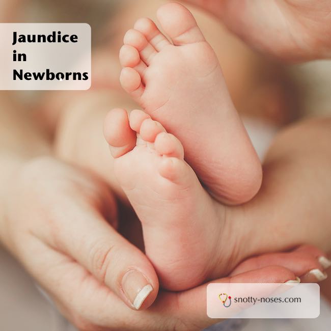 neonatal jaundice babies